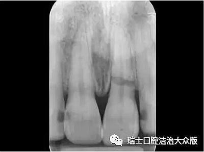 成人牙齒外傷了怎么應(yīng)急處理？