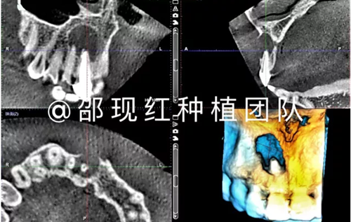 「科普篇」你真的了解它嗎？——β-磷酸三鈣