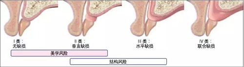 【文獻(xiàn)精讀】唇-齒-牙槽嵴分類：無(wú)牙頜上頜牙弓指南。診斷，風(fēng)險(xiǎn)評(píng)估及種植治療指征