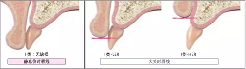 【文獻(xiàn)精讀】唇-齒-牙槽嵴分類：無(wú)牙頜上頜牙弓指南。診斷，風(fēng)險(xiǎn)評(píng)估及種植治療指征