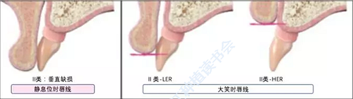 【文獻(xiàn)精讀】唇-齒-牙槽嵴分類：無(wú)牙頜上頜牙弓指南。診斷，風(fēng)險(xiǎn)評(píng)估及種植治療指征