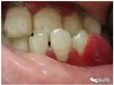牙周炎，中國成年人后半生永遠的 痛 ！