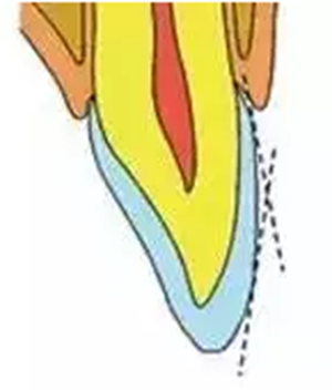 貼面?zhèn)溲乐嗌伲? alt=