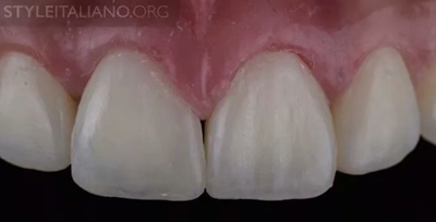 【分享】前翼技術關閉前牙間隙