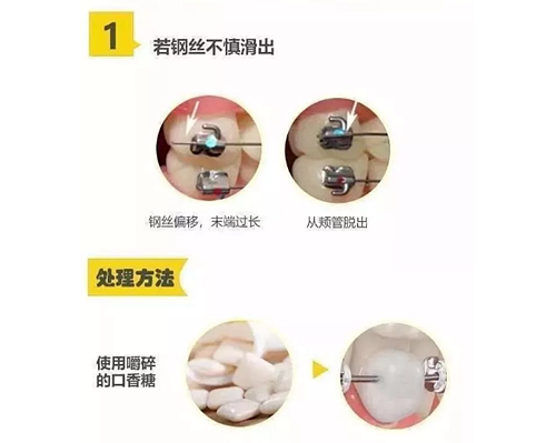 特殊時(shí)期為什么常規(guī)的口腔治療都不能做了？