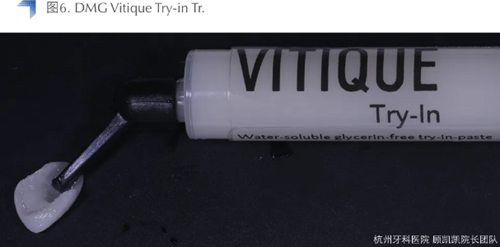 Vitique瓷貼面粘接系統(tǒng)的臨床應(yīng)用