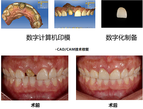 妙手牙醫(yī)丨殘根、殘冠還有保留的意義嗎？