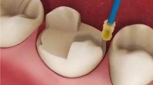 妙手牙醫(yī)丨殘根、殘冠還有保留的意義嗎？
